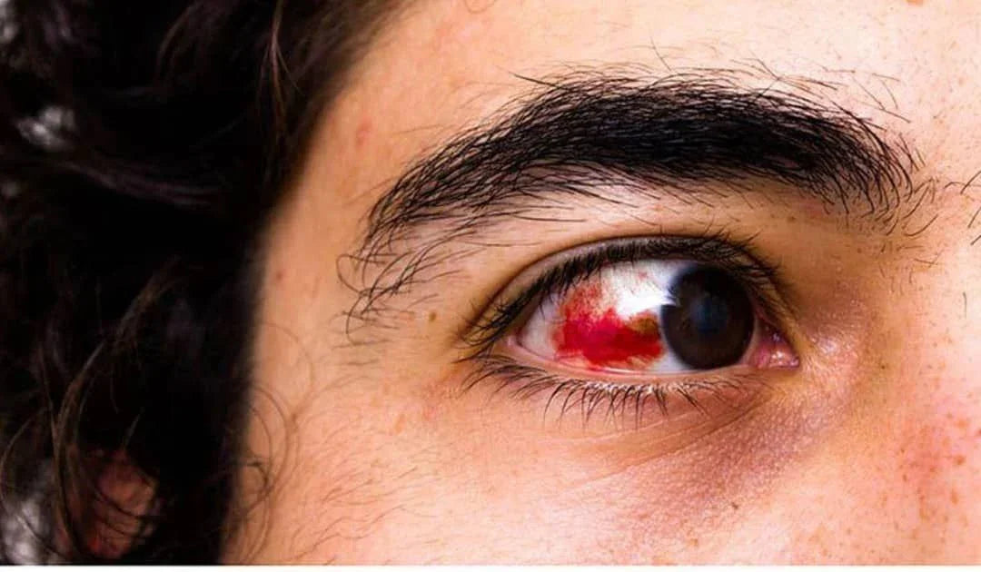 Understanding Eye Disorders