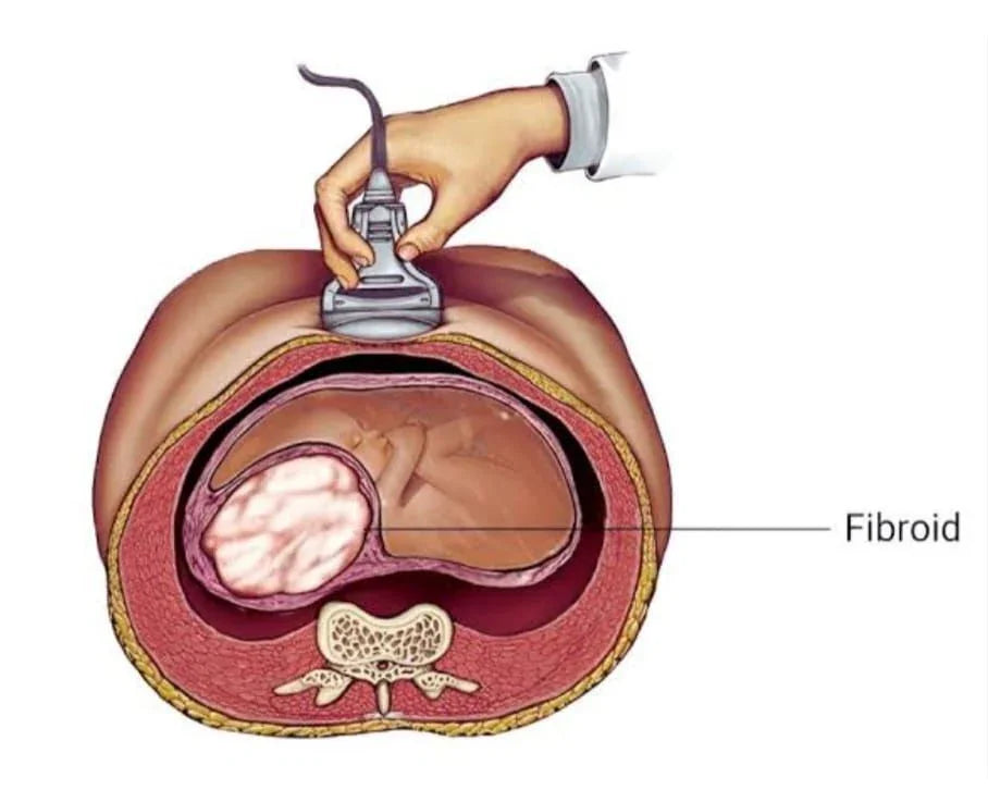 Fibroids and Pregnancy